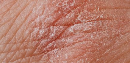 treat eczema Neath