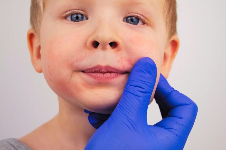 child with impetigo